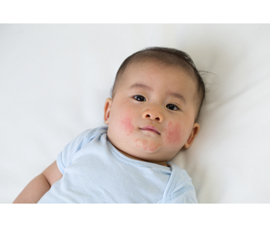 Treatment of baby rashes