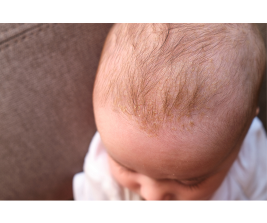 Treatment for Cradle Cap