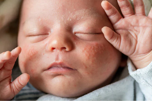 What Baby Body Wash Is Good for Eczema?